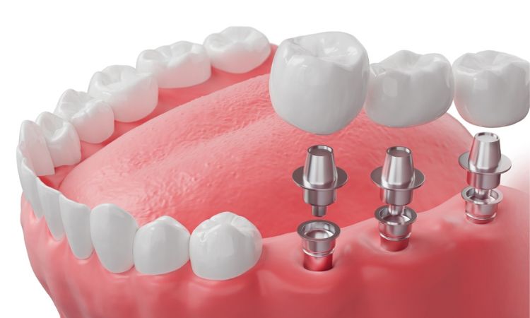 Dental Implants Arlington