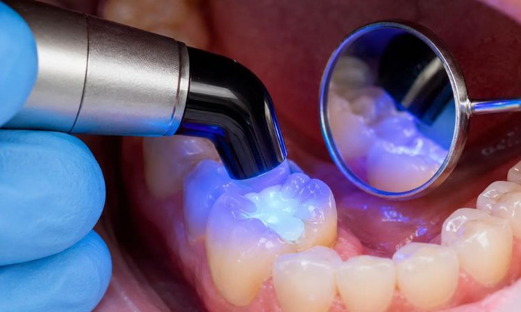 Tooth Fillings 